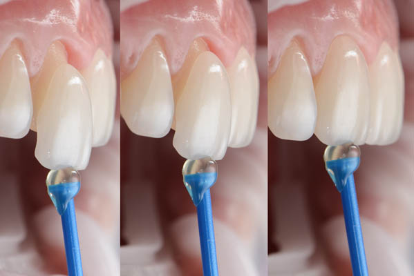 How Long Will Veneers Typically Last?