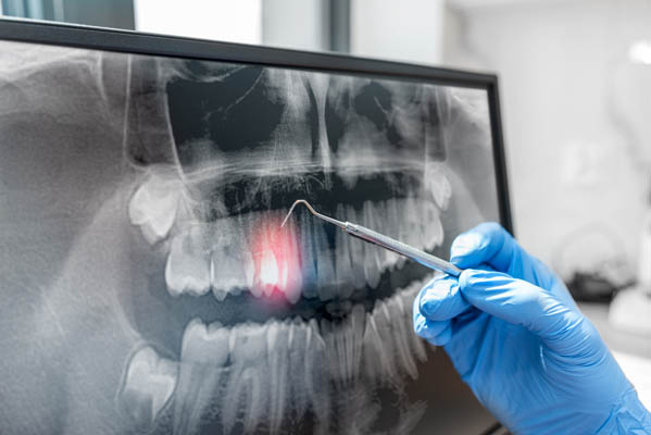 Risk Factors For Oral Cancer